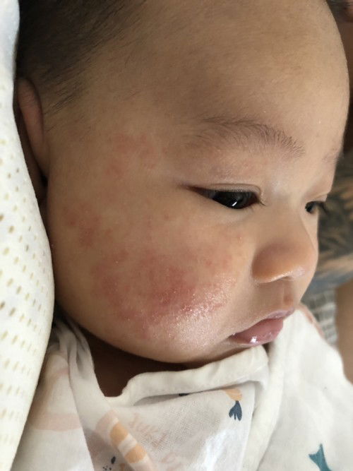 ขอสอบถามแม่ๆเรื่องผดหรือผื่นที่หน้าลูกค่ะ