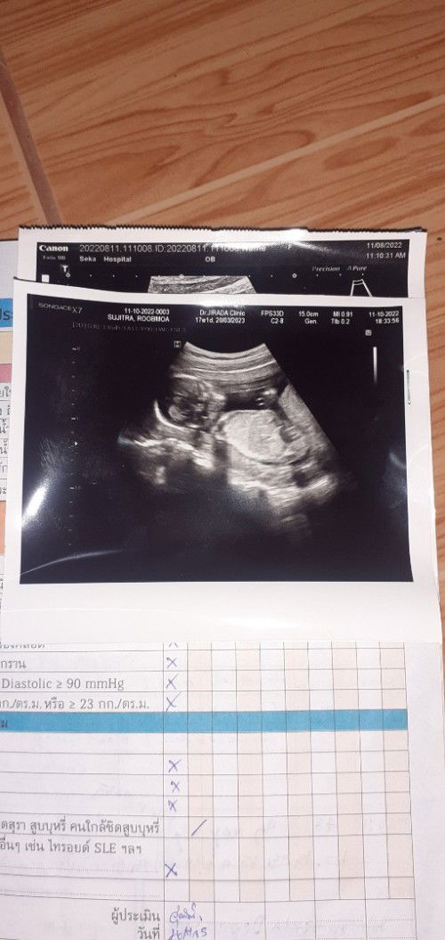 พี่ๆช่วยดูภาพอัลตร้าซาวนี้หน่อยคะเสี่ยงเป็นเด็กดาวน์ซินโดมสูง แม่ไมสบายใจเลย