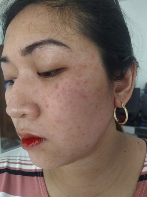 Rashes, choco na batok at lihi stage