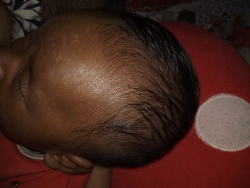 Bun klo kulit anak ada putih putihnya kek gini dikasih cream apa y biar cpt ilang