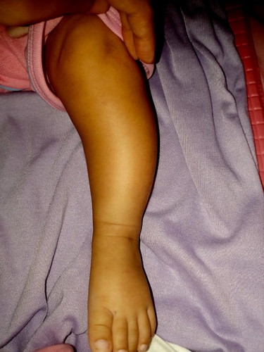 bentuk kaki bayi usia 2.5 bulan