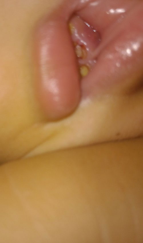 Balita usia 3 tn sakit gigi