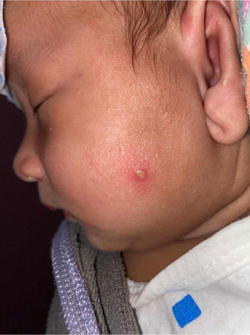 ตุ่มแบบนี้เกิดจากอะไรคะ