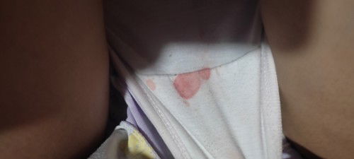 9 weeks pregnant ng Twins pero patay ang isa sa kanila ngayon may spotting ako