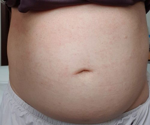 Rashes on Belly and Breasts area