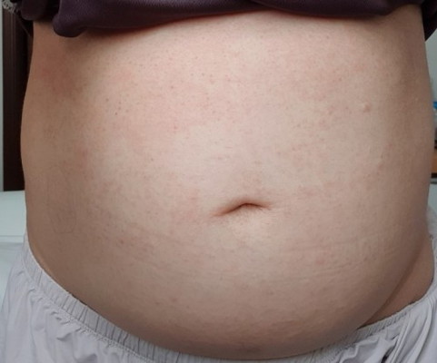 Rashes on Belly and Breasts area