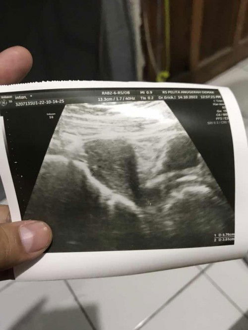 Pendarahan di usia 6week