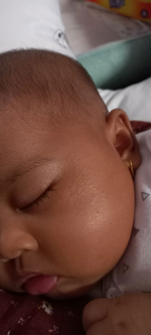 Bintik bintik di wajah