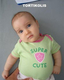 TORTIKOLIS