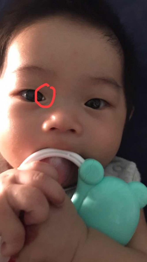ลูกได้3เดือน22วัน ตรงลูกตาขาวเป็นวาวๆตามที่วงไว้ ผิดปกติไหมค่ะ บ้านไหนมีแบบนี้บ้างค่ะ กังวลมากเลยค่ะ