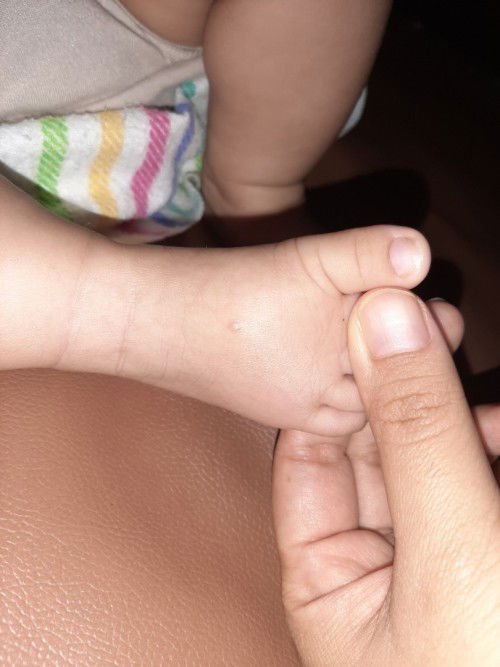 Moms ada yg tau nggak knp kaki anak saya ya? itu isinya air, waktu itu ada di tangan & skg dikaki