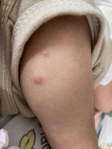 เด็กแรกเกิดปลูกฝีกี่จุด