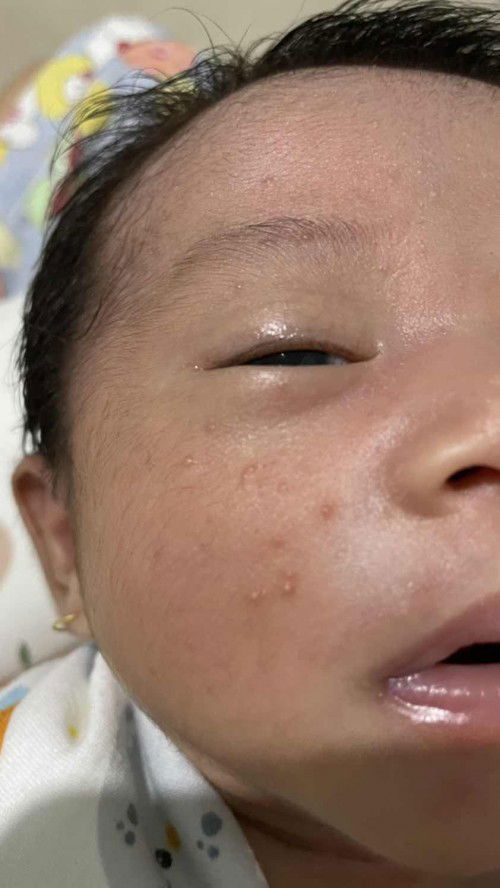 Jerawat bayi