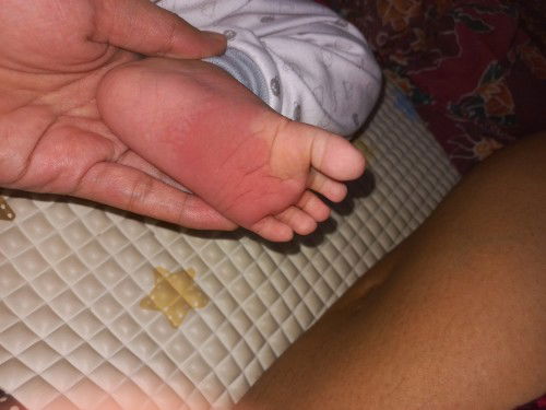 Talapak kaki bayi merah