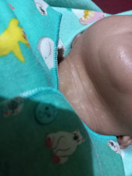 Bercak Putih di leher