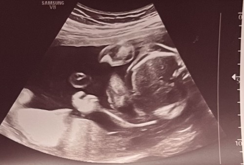 baby ultrasound