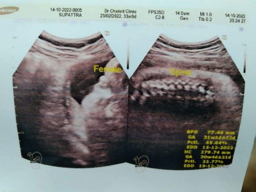 ตอนนี้หนู33weekแล้วค่ะ