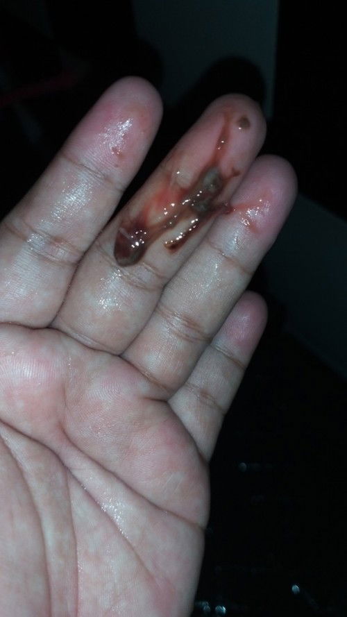 Apakah sakit pinggang ilang ada ilang ada termaksud kontraksi ?