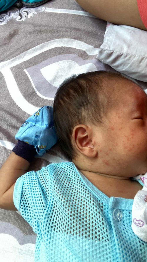 Bintik merah jerawat bayi normal kah? Mcm mana mau hilangkan?