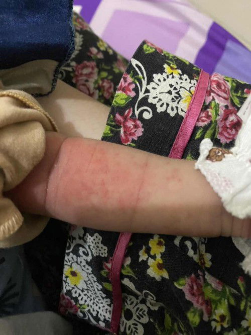 Bintik2 merah pada bayi