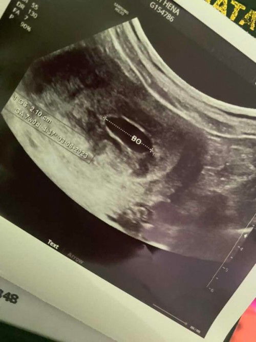 Di usg 7w , ini usg k 2x nya dan masih ada kantung nya aja.. 🤧