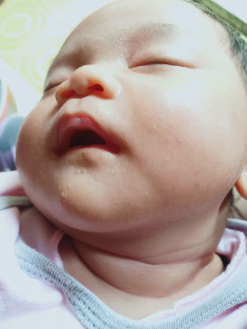 Bintik bintik pada bayi 1 bulan