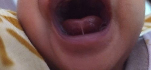 Tongue tie