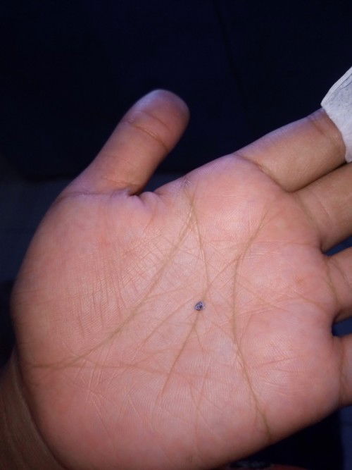 Benang yg di ujung bekas operasi Caesar copot