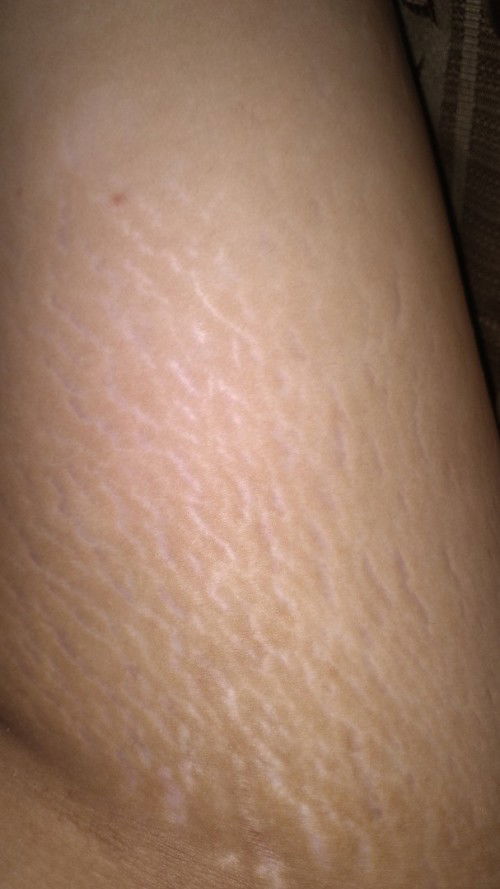 Bun Ada yang sama gak nih,trim3 muncul banyak strech mark kek gini. Di paha,perut,bokong dn payudara