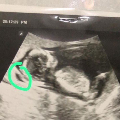 Pendarahan di dalam kandungan