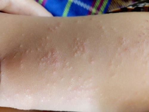 ผดผื่นในเด็ก 