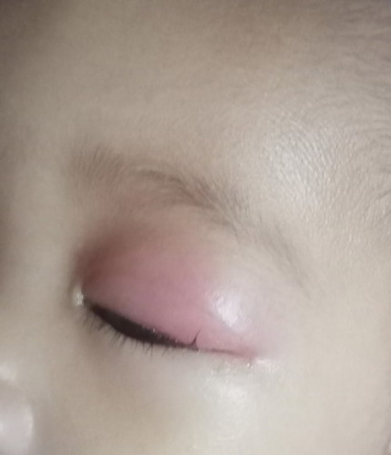 Namamagang mata ni baby