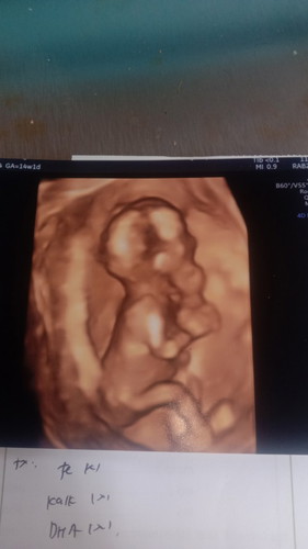 USG 14weeks