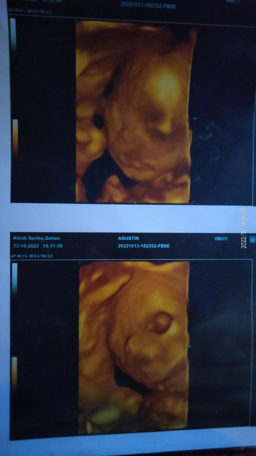 Bingung dengan hasil USG