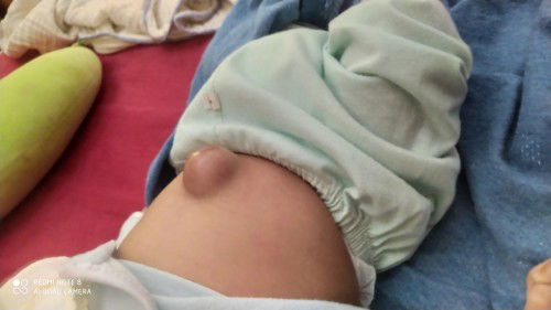 Con e 28 ngày tuổi mà rốn bị như thế này không biết có bị ls k ạ . có mom nào có con bị như này k ạ
