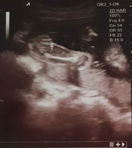 Membaca hasil usg jenis kelamin