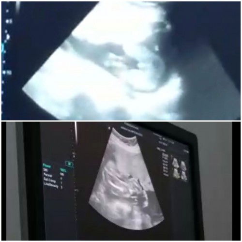 Hasil usg yang berbeda ada yang pernah mengalami?