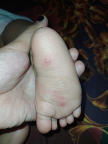 Bun nanya dong ini bahaya ngga yaa ,, tiba" kaki anak saya kaya gini .. obatnya apa yah