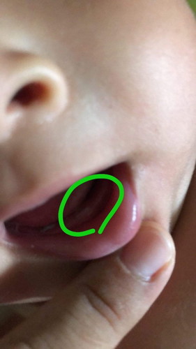 แบบนี้ฟันน้องขึ้นไหมคะ
