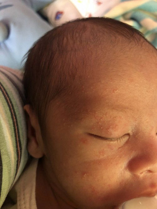 ผื่นขึ้นตามใบหน้าเด็กแรกเกิด