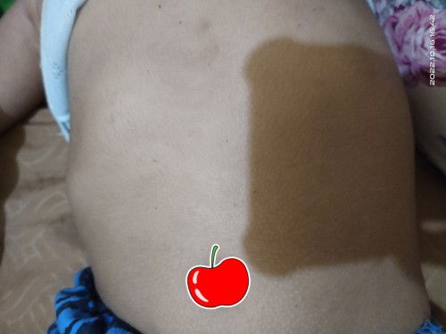 Tulang rusuk kanan menonjol