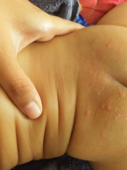 Ruam popok atau apa ya buun