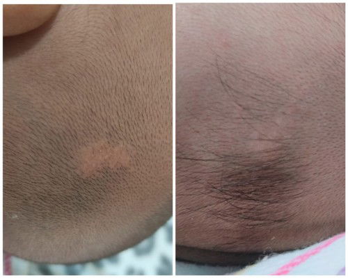 Kulit kepala tidak tumbuh rambut