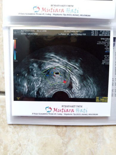 Hamil menurut hpht 8 Minggu
Tapi kenapa pas di USG katanya 5/6 minggu