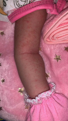 Bintik ruam pada badan bayi