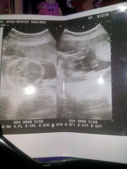 Hasil USG jenis kelamin