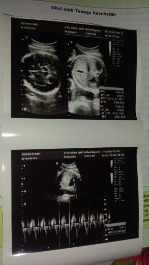 lebih akurat mana hpl atau edd?