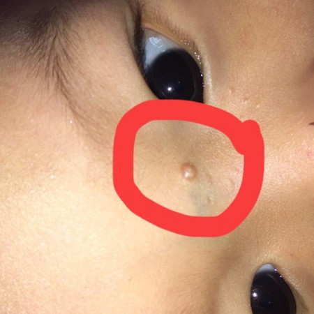 มันคือตุ่มอะไร ตุ่มขาวใสขึ้นแค่ตุ่มเดียว