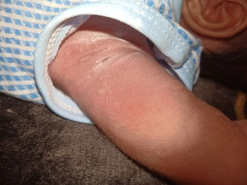 Ada gak disini yg bayinya ada bintik2 tpi ber air bun, adanya cuma lipatan ketiak sama bawah pusar