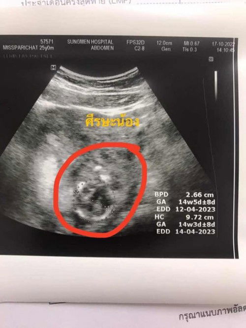 ขอดูภาพอัลตราซาวด์ของแม่ๆที่ตั้งครรภ์ได้14+5หน่อยคะ